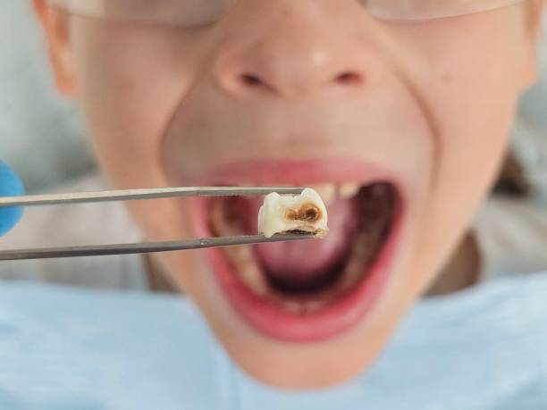 Best Root Canal Emergency Dentist  in Carbondale, PA